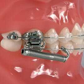 Orthodontic Appliances